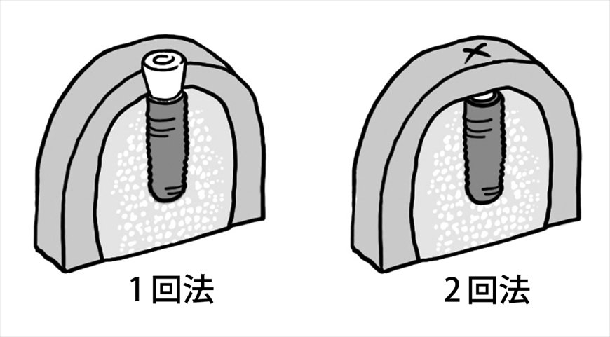 1回法と2回法のイメージ（歯ぐきの断面）