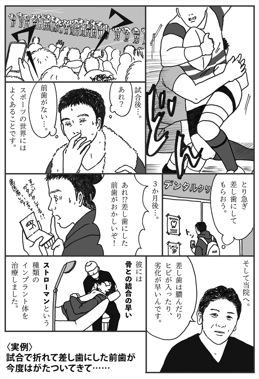 ラグビー選手の劣化してしまった差し歯をストローマンで治療した例