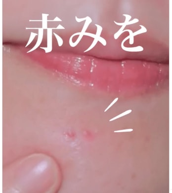 【ニキビの赤み対策】30代40代必見！長時間メイクでも白浮きしにくい徹底カバーのコツが目からウロコ！