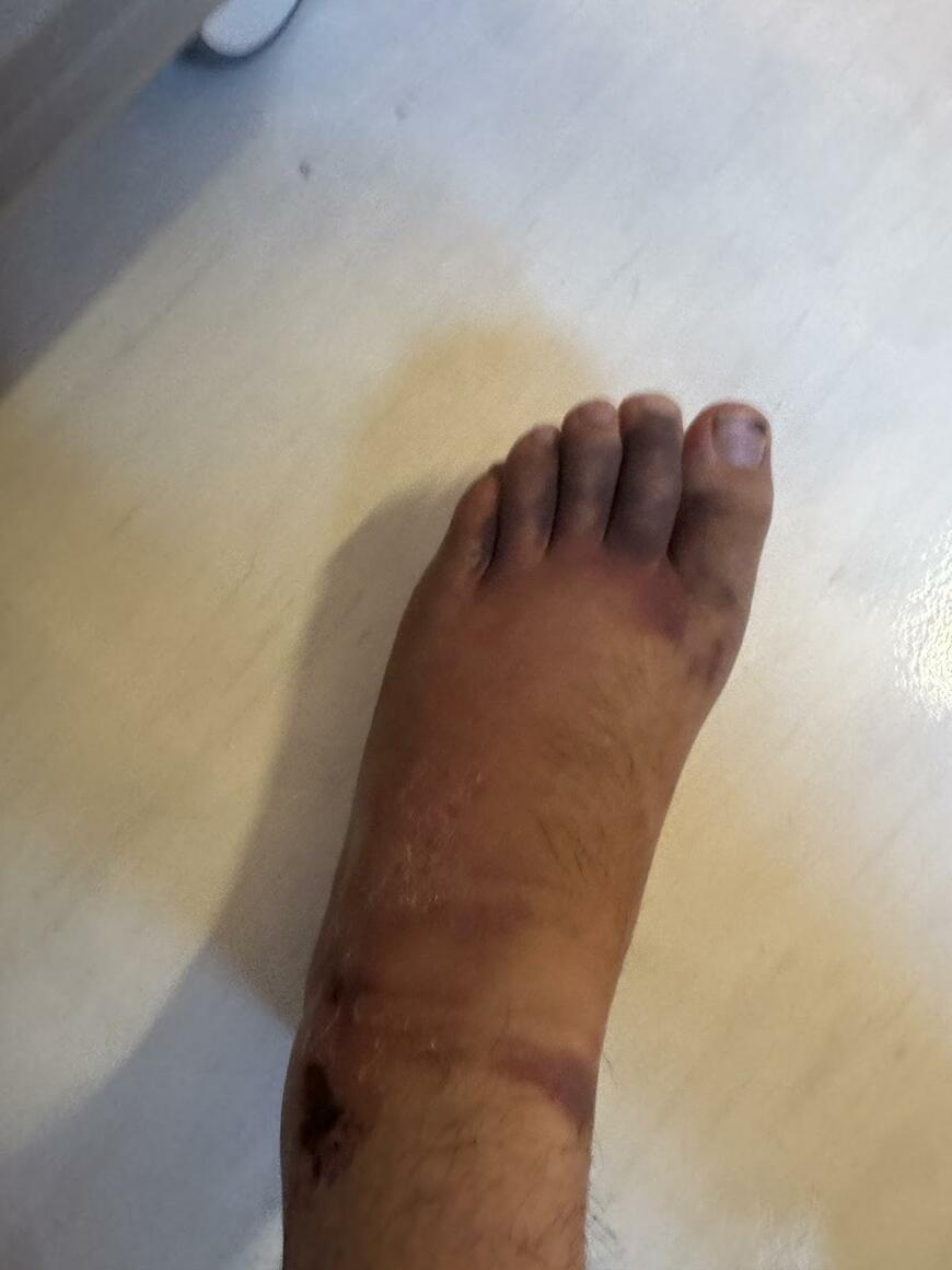 12トンのクレーン車に踏まれた足